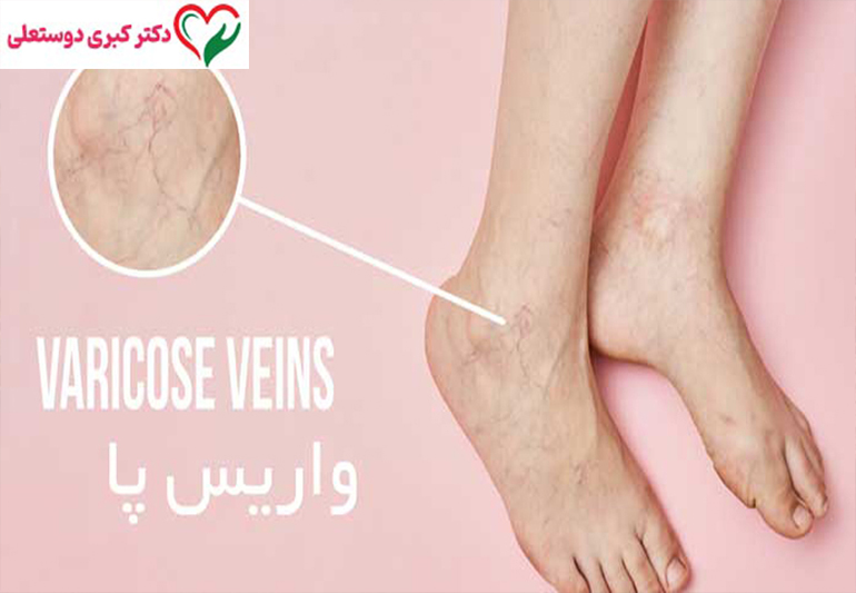 تحقیقات جهانی درباره نقش التهاب در ایجاد و پیشرفت واریس