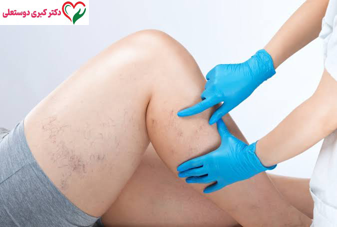 زخم ناشی از واریس چه شکلی است؟