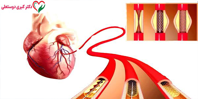 ورزش پس از آنژیوگرافی