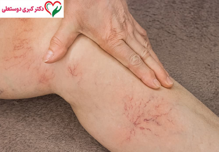 تحقیقات جهانی درباره نقش التهاب در ایجاد و پیشرفت واریس