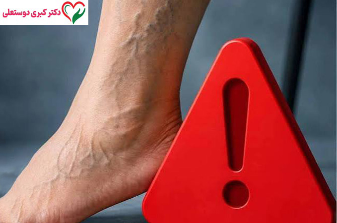 آیا بعد از ورزش باید پاها را بالا گذاشت؟